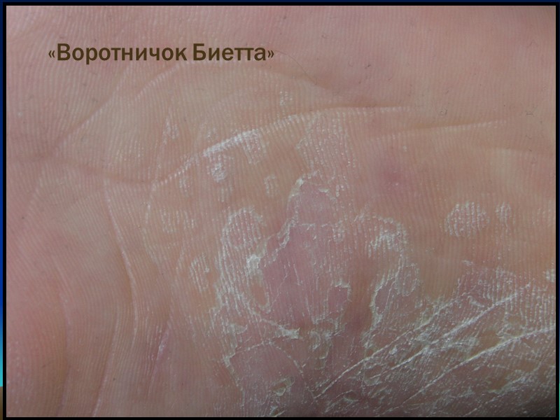 «Воротничок Биетта»